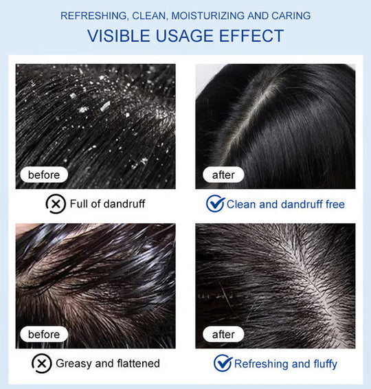 Selenium Disulfide Anti-dandruff Shampoo