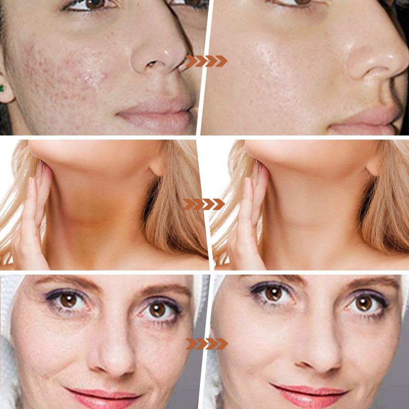 🥇Buy 1 Get 1 Free🧼Lemon Turmeric & Kojic Acid Soap Bars